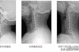 【医者解读】颈椎生理曲度变直怎么办？图片