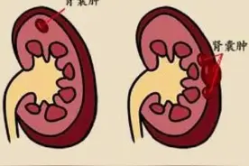 肾囊肿的危害与注意事项图片