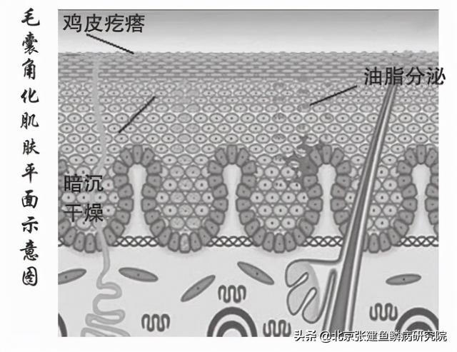 长鸡皮疙瘩一样的皮疹黑了