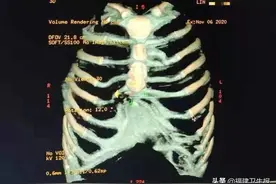 福州5岁女童前胸贴后背，凹陷距离脊椎不足5厘米！医生提醒：漏斗胸跟缺钙没多大关系图片