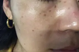 祛斑记录，超皮秒图片