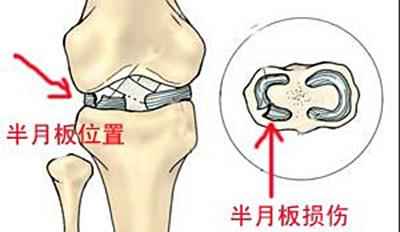 老人关节炎或者半月板不好，吃氨基葡萄糖或者软骨素有用吗？