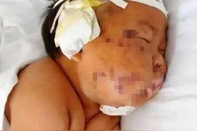因吃奶太用力，被妈妈用剪刀划花的男孩，如今怎么样了图片