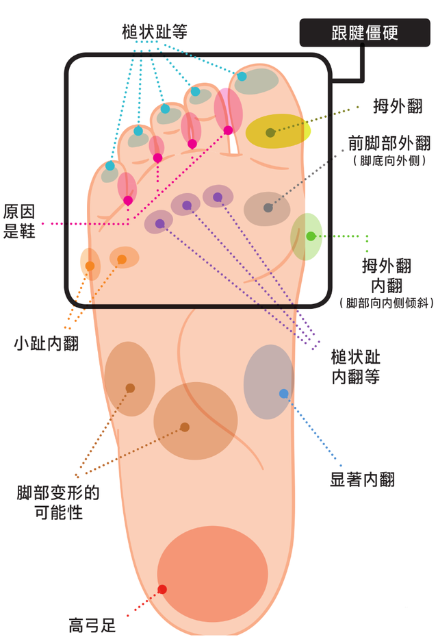 角化过度型足癣脂肪肝
