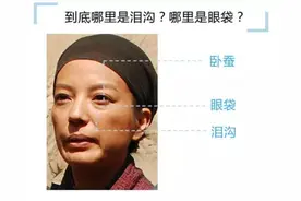 泪痕沟的形成原因及解决方法图片