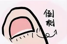 知名女演员因拔倒刺住院动手术！医生：严重可致截肢……图片