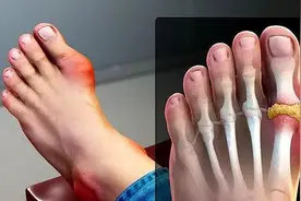 痛风为什么总是从脚趾开始？其它部位会有吗？图片