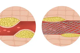 放了支架15年，钟南山身体依然健朗，看看他的保养方法图片