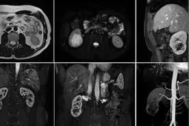 微创精准切除肾肿瘤——山东医专第一附属医院特聘专家为患者拆掉威胁健康的炸弹图片