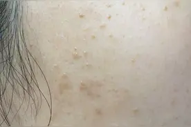 为什么扁平疣患者越来越多？它的传染性究竟有多强？图片