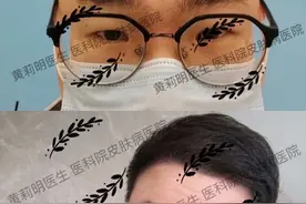男女发际线种植需看脸定制图片