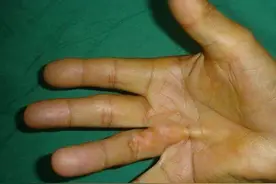 掌腱膜挛缩，您知道多少？图片
