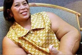 泰国女子患上怪病，”拥有世界上最大的手，生活上却少不了烦恼！图片