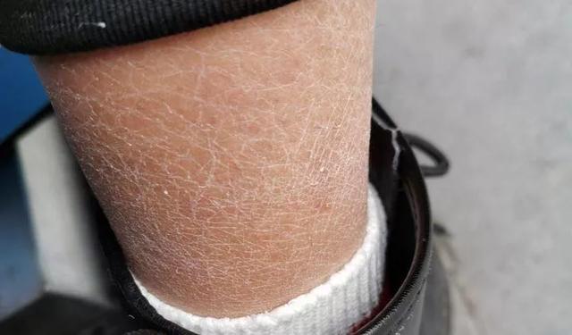 人的皮肤像鸡皮一样的 人的皮肤像鸡皮一样的