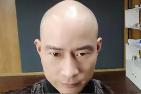 脱发秃顶的终极解决方案图片