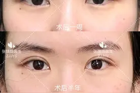 全切双眼皮多久会消肿？图片