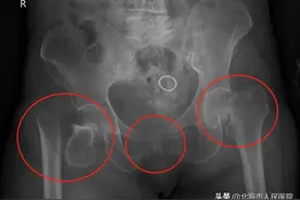 【救死扶伤】多学科合作，经三次手术，一个月后，重伤的陈婆婆从重症监护室搬出来了图片