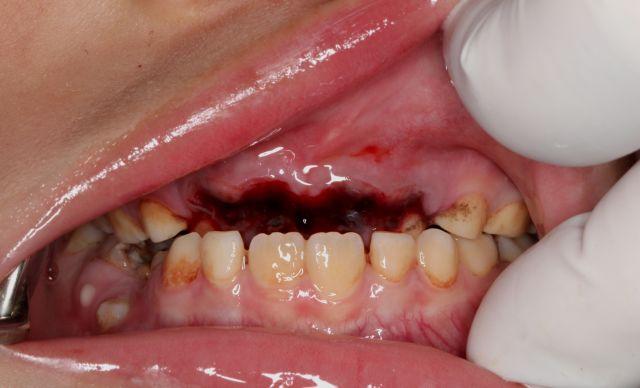 宝宝牙齿磕掉了,磕松了,怎么办呀?