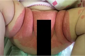 有些顽固性尿布疹，其实可能是银屑病图片