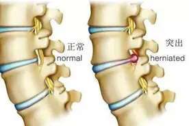 吊单杠治疗腰椎间盘突出？高医生来补充两句！图片