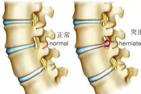 吊单杠治疗腰椎间盘突出？高医生来补充两句！图片