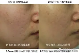 【微针】“滚”出来的无暇素颜美肌图片