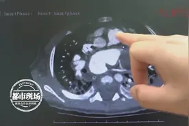 5月大婴儿心脏竟有成人般大小，医生：血管搭错了，很致命图片