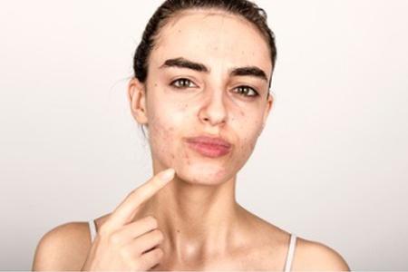 用完身体乳长痘