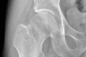 看得我胯骨轴发酸 ——正确认识股骨颈骨折严重并发症图片