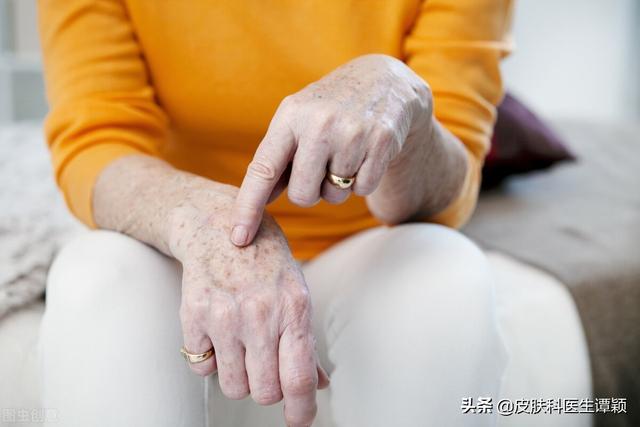 大片脂溢性角化病怎么治疗