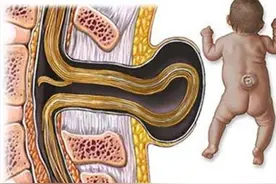 千万不要小看先天性脊柱裂！早期发现蛛丝马迹，对症治疗是关键图片