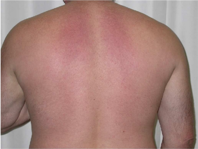 角化过度角化不全炎症