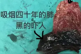 没有肺大泡就形成不了慢阻肺，预防的首要任务是戒掉这个坏习惯图片