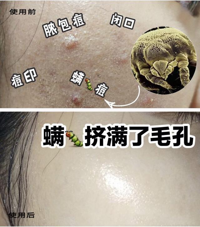 吸出痘痘中停留的螨虫,爆痘老阿姨变身无瑕肌小姐姐~一方面杀死螨虫