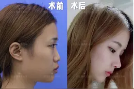 鼻基底填充到底用哪种材料，才不影响表情？图片