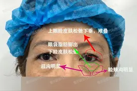 眼周年轻化提眉手术+外路祛眼袋，52岁姐姐眼周至少年轻了20岁图片