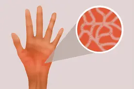 有了荨麻疹后，吃什么好，吃什么不好，清单列给你图片