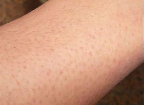 手臂毛囊角化怎么除掉