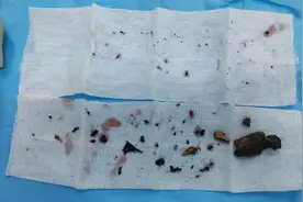 男子酒后乘摩托车摔入树丛，眼睛里取出几十块碎片，医生：视力恐难恢复图片