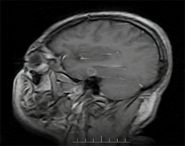 丙酸血症，一种常染色体隐形遗传，造成生化遗传症状，要及时预防