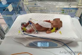 洛阳：新生儿患鱼鳞病，出生仅980克 70个日夜抢回孩子一命图片