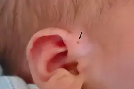 孩子耳朵有一个小孔？不是老人说的“有福气”！爸妈要心里有数图片