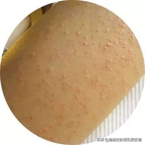 鱼鳞病在越南生活