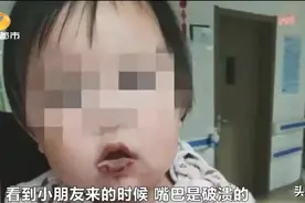 长沙1岁女童误食疏通剂，嘴唇、口腔灼伤，紧急送医图片