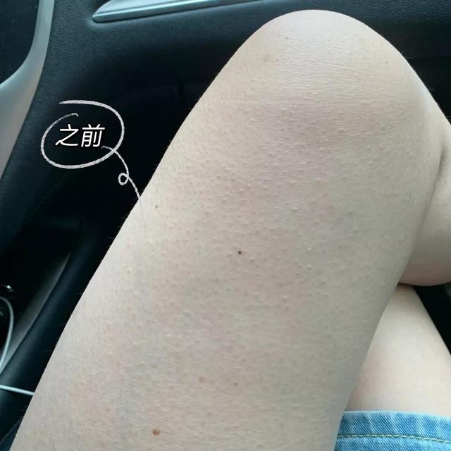 果酸换肤治疗鸡皮肤要一直做吗