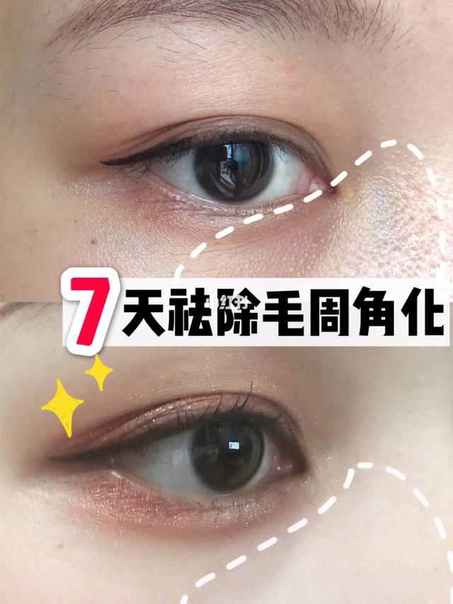 激光去毛周角化症多少钱