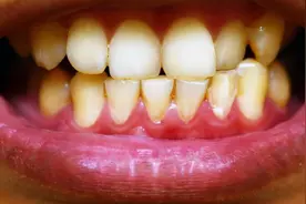 “牙结石”可以用手抠掉吗？教你一招，牙缝里的脏东西或能轻松掉图片