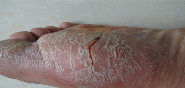 国医大师谈角化型手足癣验方