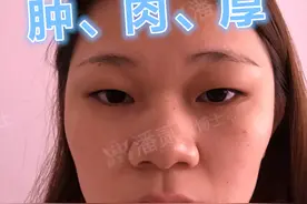 什么类型的肿眼泡/肿泡眼，别指望变薄眼皮？—眼整形双眼皮手术图片