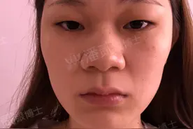 什么类型的肿眼泡/肿泡眼，别指望变薄眼皮？—眼整形双眼皮手术图片